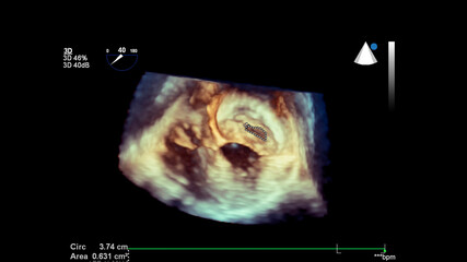 3D image of the heart during transesophageal ultrasound of the heart.