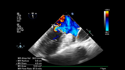 Image of the heart during transesophageal ultrasound with Doppler mode.