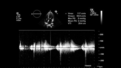 Image of the heart in gray-scale mode during transesophageal ultrasound.