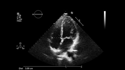 Image of the heart in gray-scale mode during transesophageal ultrasound.