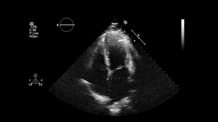 Image of the heart in gray-scale mode during transesophageal ultrasound.