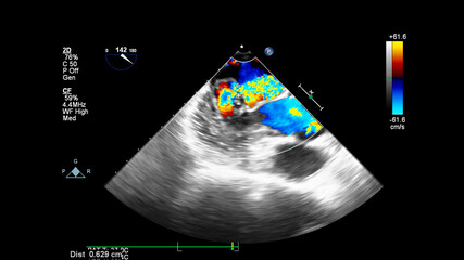 Image of the heart during transesophageal ultrasound with Doppler mode.