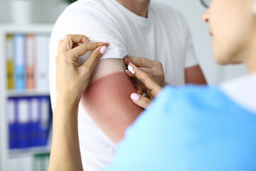Nurse applies sunburn cream to patient. Sunburn products and creams concept