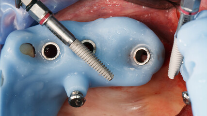 dental implant before insertion through a surgical template