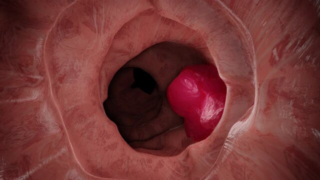3D Animation of the colon during a enteroscopy with a intestinal or bowel cancer tumor visible.