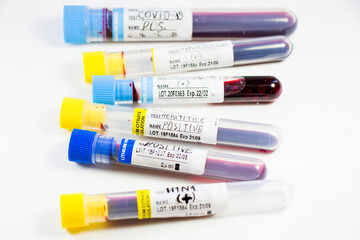 H1N1, Covid-19, Hepatitis C, Tuberculosis and Staphylococcus viruses blood tests in the tubes, laboratory diagnostics