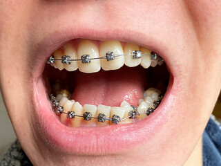 Obraz premium Open mouth with braces on teeth. Orthodontics and bite correction.