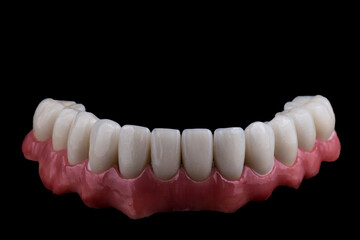 ceramic crowns done on 8 implants