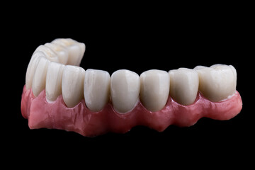 ceramic crowns done on 8 implants