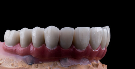 Fototapeta na wymiar ceramic crowns done on 8 implants