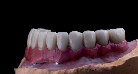 ceramic crowns done on 8 implants