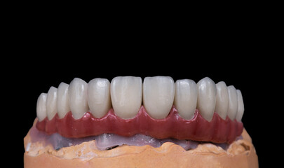 ceramic crowns done on 8 implants
