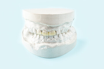 Stomatologic plaster cast, molds of human jaws and teeth on blue background. Dental casting gypsum for manufacture of dentures, braces or false teeth. Dentistry and orthodontics concept. © Elena