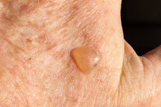Raised blister caused by cryotherapy to remove solar keratosis lesion