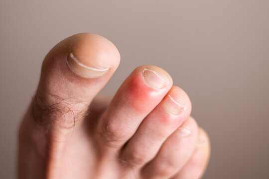 Detail of foot with chilblains on his fingers. Illness caused by cold.