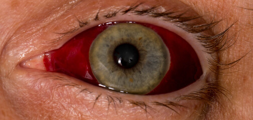 Human eye with subconjuctival hemorrhage, broken blood vessel, close up