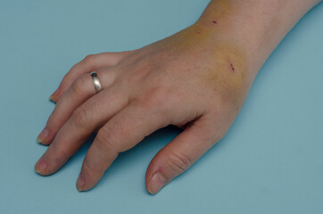 Hand of middle-aged Caucasian woman with bruises and wounds.
