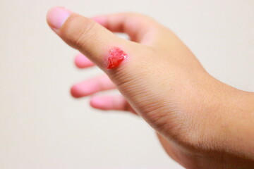 乾燥肌が悪化して化膿して出血した男性の手
