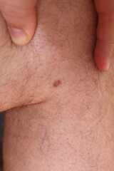 health and wellness - photo of a dermato fibroma on the leg