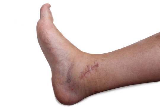 scar on the post-operative ankle