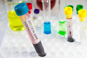 Mononucleosis and Epstein-barr virus blood test sample in lab