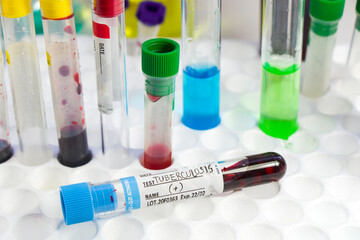 Tuberculosis blood test tube, laboratory and chemical instruments, diagnoses and research