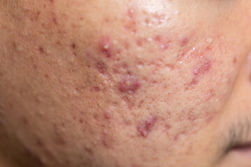Backgrounds of lesions skin caused by acne on the face in the clinic.
