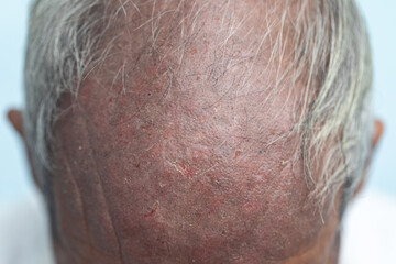 Naklejka premium A physical of Atopic dermatitis (AD), also known as atopic eczema, is a type of inflammation of the skin (dermatitis). 