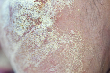 Fototapeta premium Backgrounds of lesions skin caused by acne on the face in the clinic. 