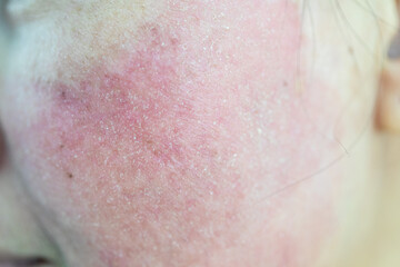 Backgrounds of lesions skin caused by acne on the face in the clinic.
