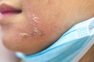 Fototapeta premium Backgrounds of lesions skin caused by acne on the face in the clinic. 