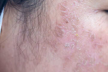 Fototapeta premium Backgrounds of lesions skin caused by acne on the face in the clinic. 