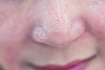 Backgrounds of lesions skin caused by acne on the face in the clinic.
