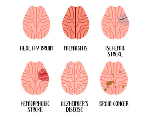 Brain diseases. Meningitis, ischemic and hemorrhagic stroke, alzheimer's disease, cancer. Neurobiology. Vector flat illustration. Perfect for flyer, medical brochure, banner, landing page, website