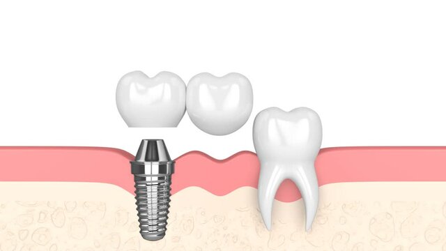 Gums with implant supported dental cantilever bridge isolated over white background