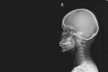 x-ray of human cervical spine and  head skull.