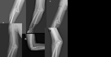 Collection x-ray elbow joint showing dislocations and fracture radial head are among the most common elbow fractures.