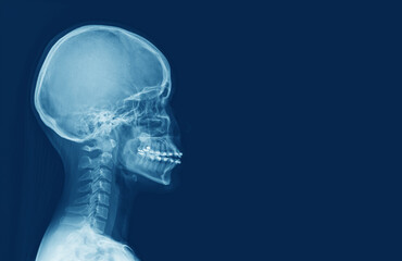 x-ray of human cervical spine and  head skull