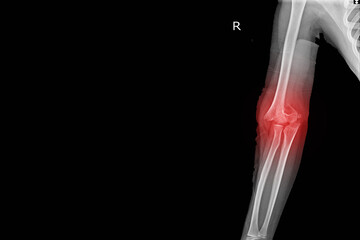 X-ray Elbow joint Finding Supracondylar fracture distal humerus with joint effusion.Medical image...