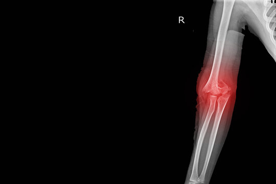 X-ray Elbow joint Finding Supracondylar fracture distal humerus with joint effusion.Medical image concept.