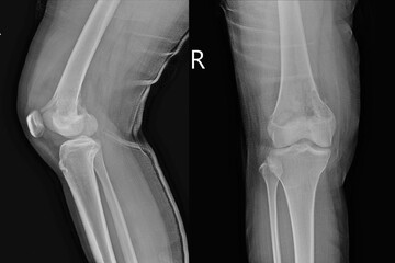 x-ray knee joint (AP,LATERAL)Views showing Osteosarcoma.