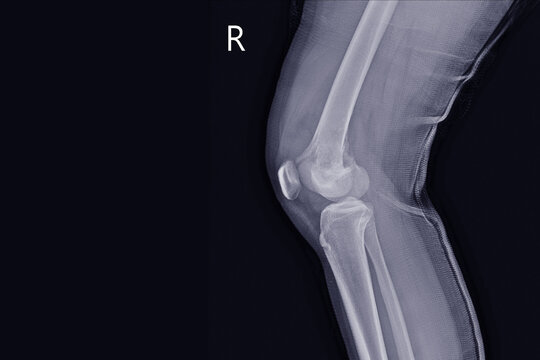 X-ray Knee join a female 15 year old Showing large osteolytic lesuion of medial aspect of right distal femur.with soft tissure mass.and malignant bone tumor,osteosarcoma is suspected.
