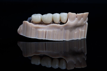 dental model made of resin and temporary dental bridge for chewing teeth