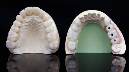 dental veneers and crowns with beautiful morphology of teeth on a black background with creative reflection