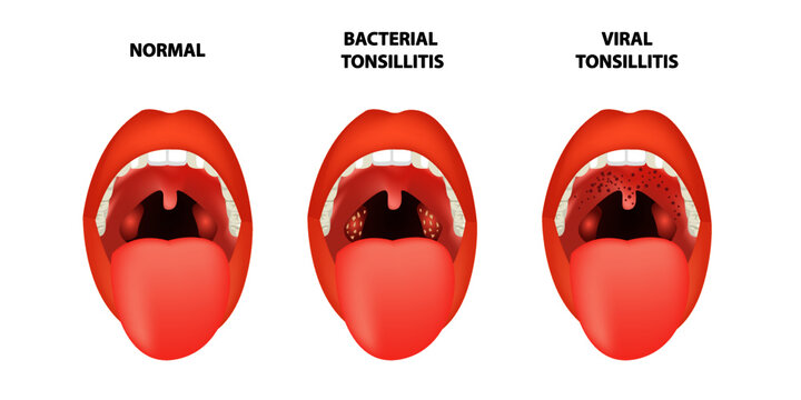 Healthy Tonsils Vs Unhealthy, Tonsillitis Causes Symptoms Treatment ...