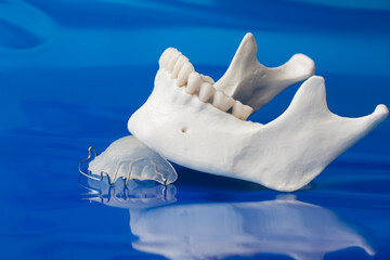 Model of lower jaw with mandibular dentition positioned on removable brace for correction of malpositioned teeth on blue background