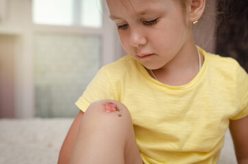 focus on broken baby knee. A little sad girl examines and processes her Scraped broken knees. Childhood injuries