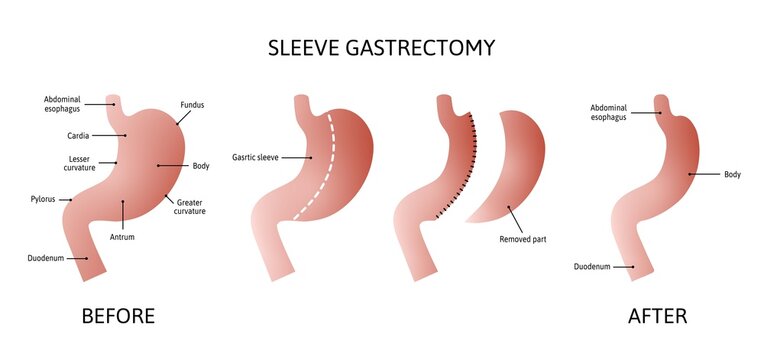 Vertical Sleeve Gastrectomy. Human stomach anatomy isolated on white background. decrease in stomach volume. vector illustration marked with lines.