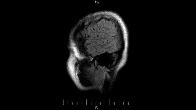 MRI brain scan, monochrome magnetic resonance imaging of a human head side view, time lapse
