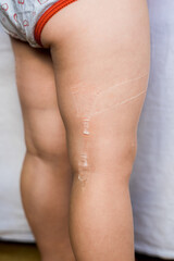 child's damaged skin, poured glue on legs and arms, leg injury, glue stuck. little baby girl at the pediatrician's appointment